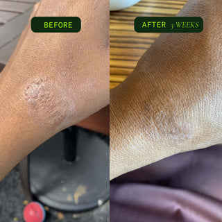 Before and after image showing skin improvement in 3 weeks with Coriander Seed Omega Body Oil.